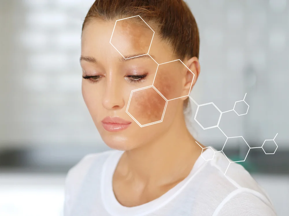 Remoção de melasma a laser