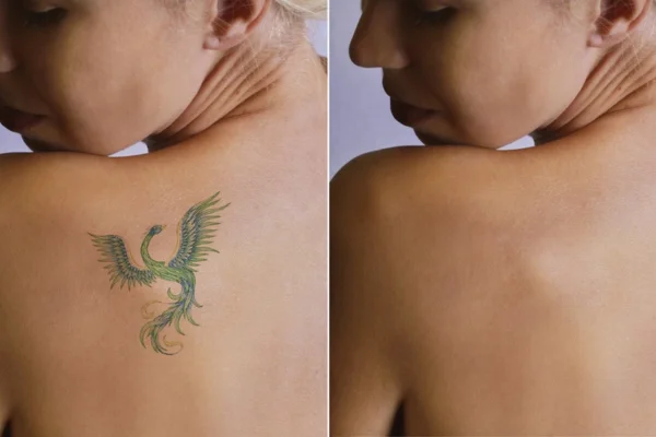 Remoção de tatuagem a laser