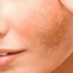 Tratamento a laser de melasma